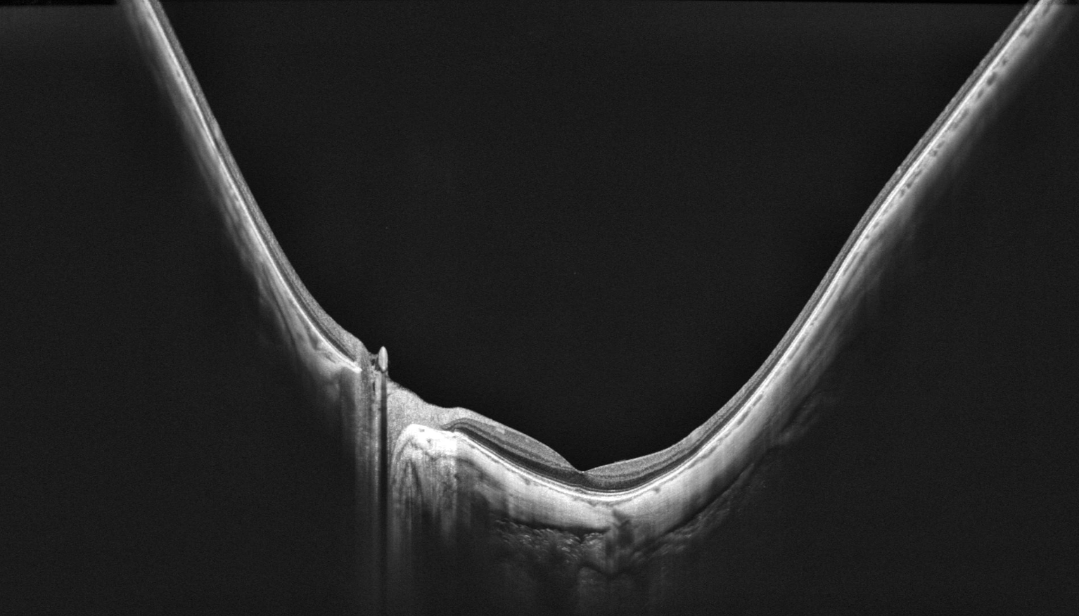 OCT montrant un staphylome myopique postérieur avec déformation du pôle postérieur et amincissement choroïdien
